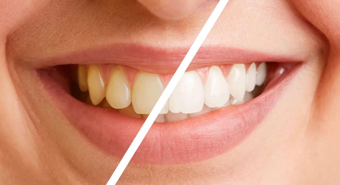 Sorriso prima e dopo lo sbiancamento